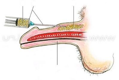 ін'екцыйнае павелічэнне пеніса